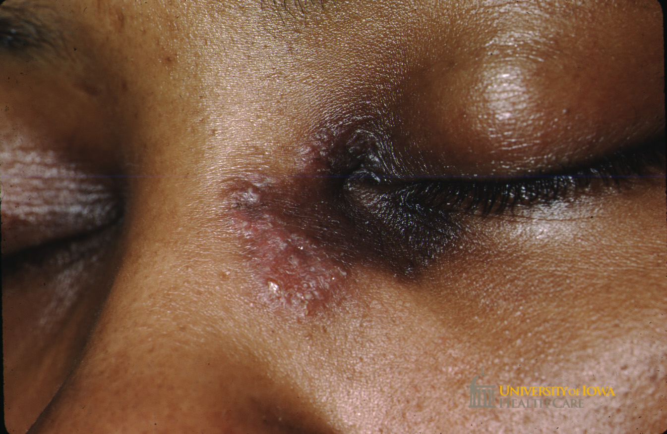 Pink plaque with overlying papules and pustules on the nasal dorsume and medial canthus. (click images for higher resolution).